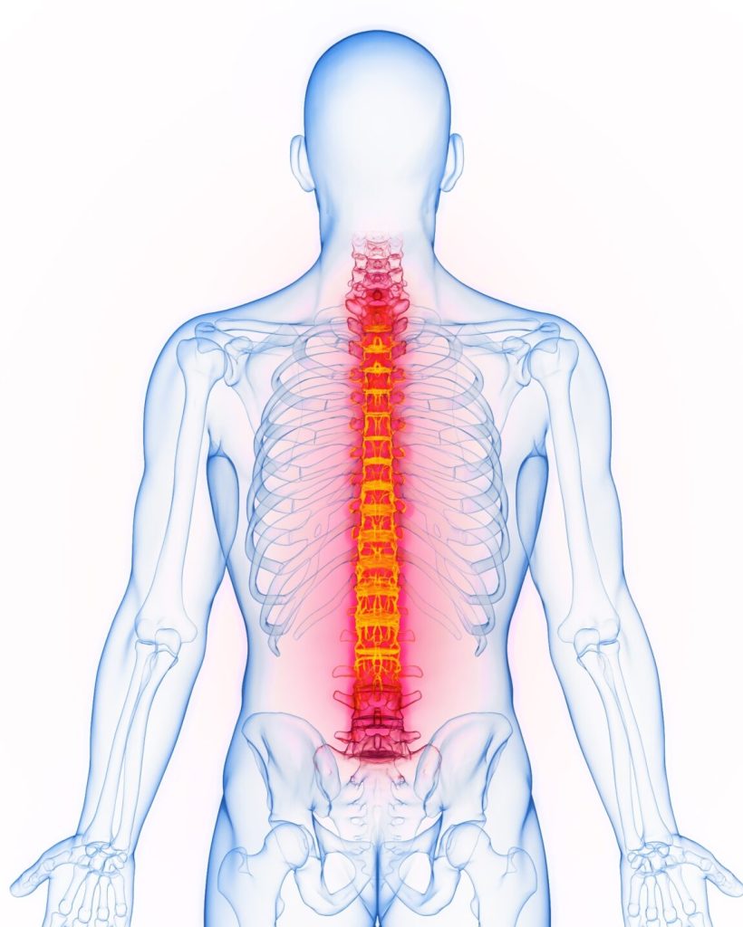 3d,Rendered,Medical,Illustration,Of,Male,Anatomy,-,Inflamed,Spine.